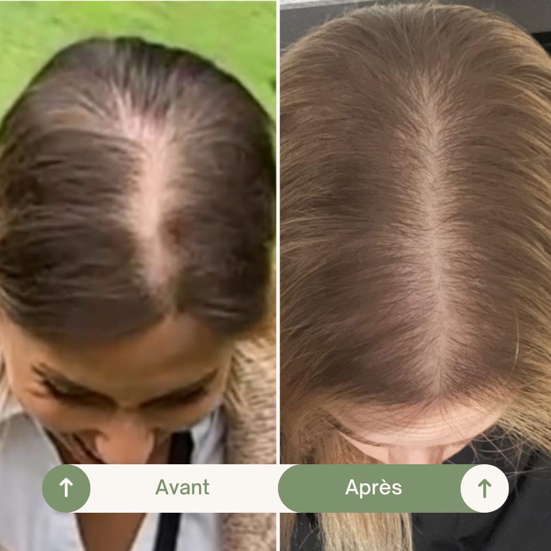 Accelerator Oil - Huile pousse cheveux naturelle & anti-chute