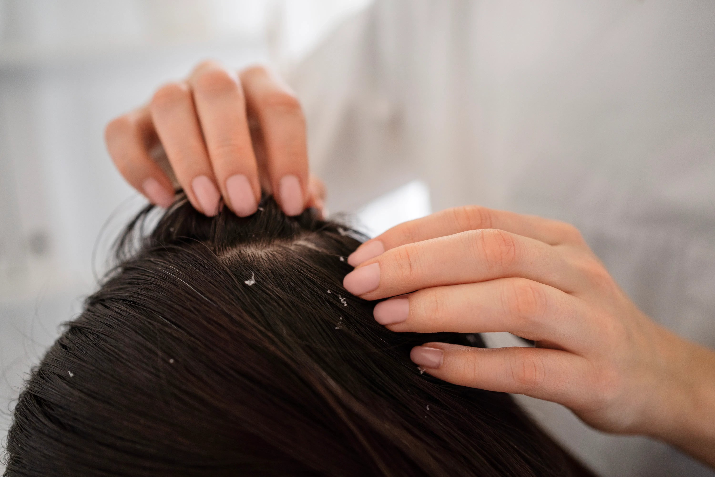 Golfes dégarnis et cuir chevelu visible chez une personne confrontée à une perte de cheveux
