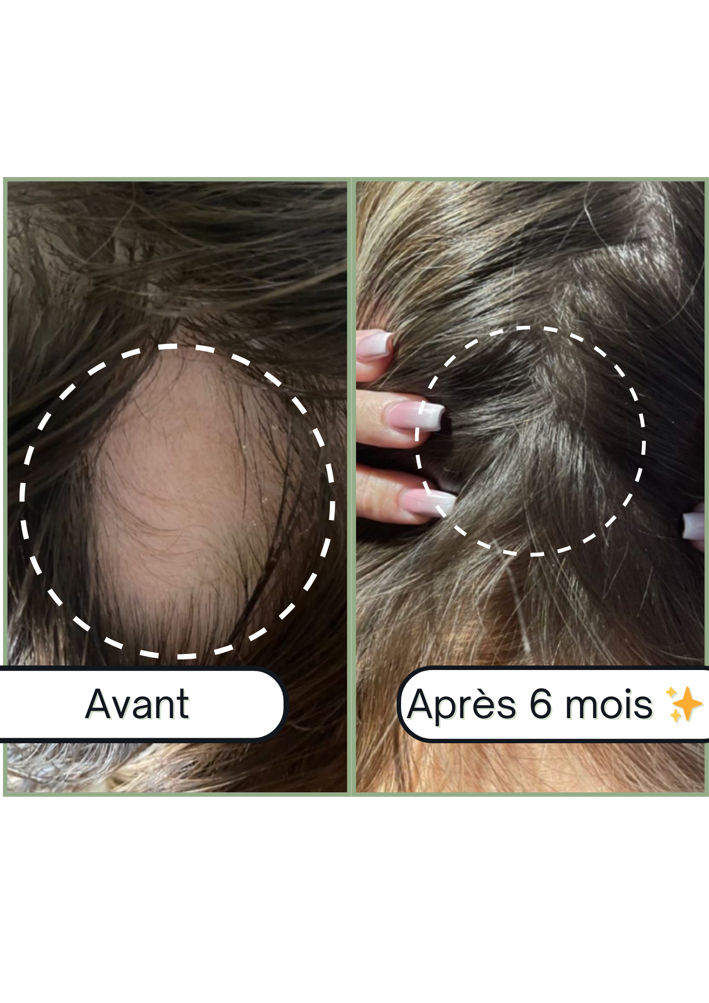 Accelerator Oil - Huile pour la pousse de cheveux &amp; Anti-chute naturelle