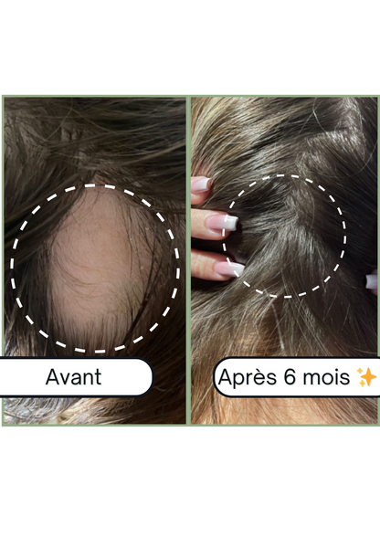 Accelerator Oil - Huile pour la pousse de cheveux &amp; Anti-chute naturelle