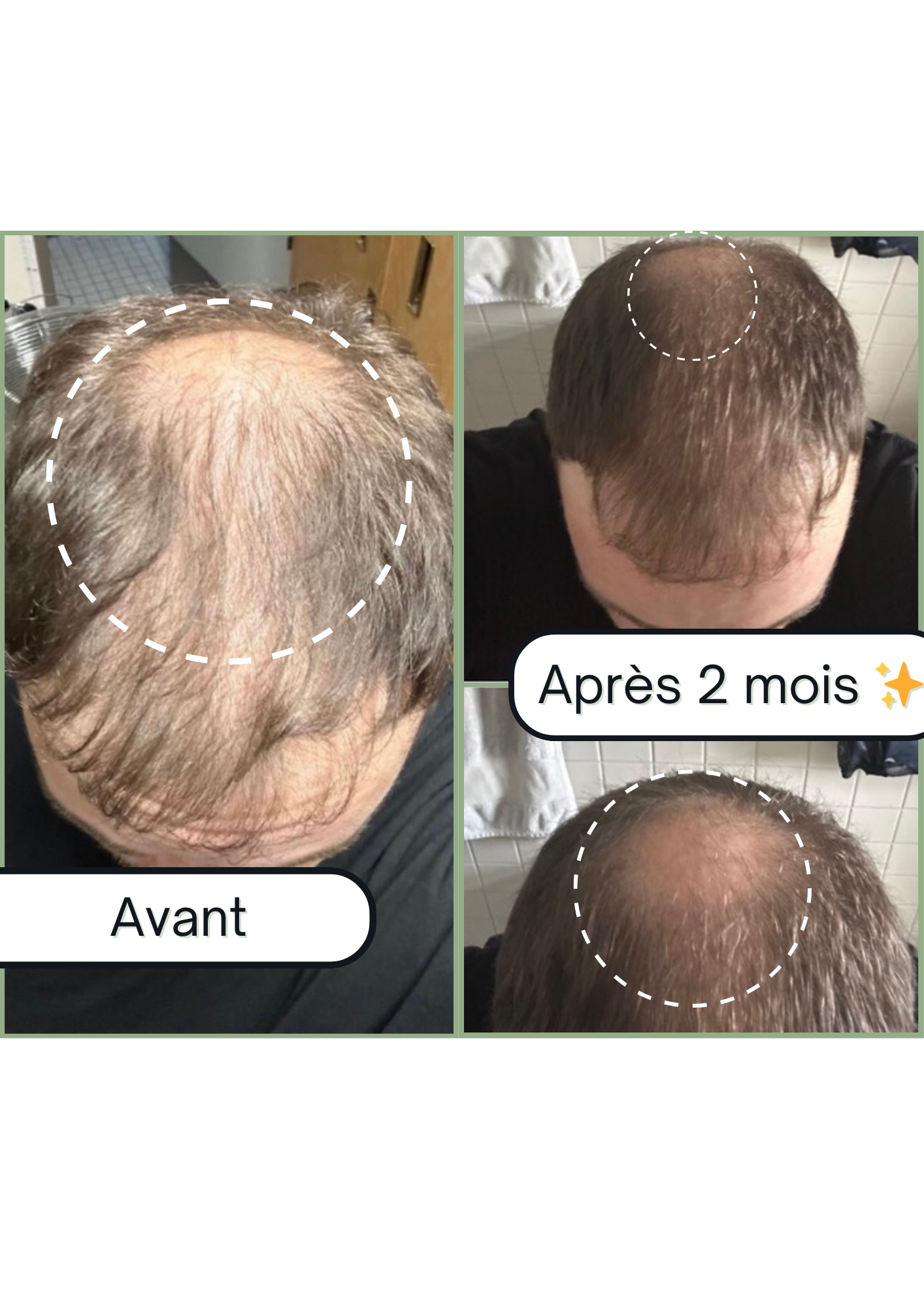 Accelerator Oil - Huile pour la pousse de cheveux &amp; Anti-chute naturelle