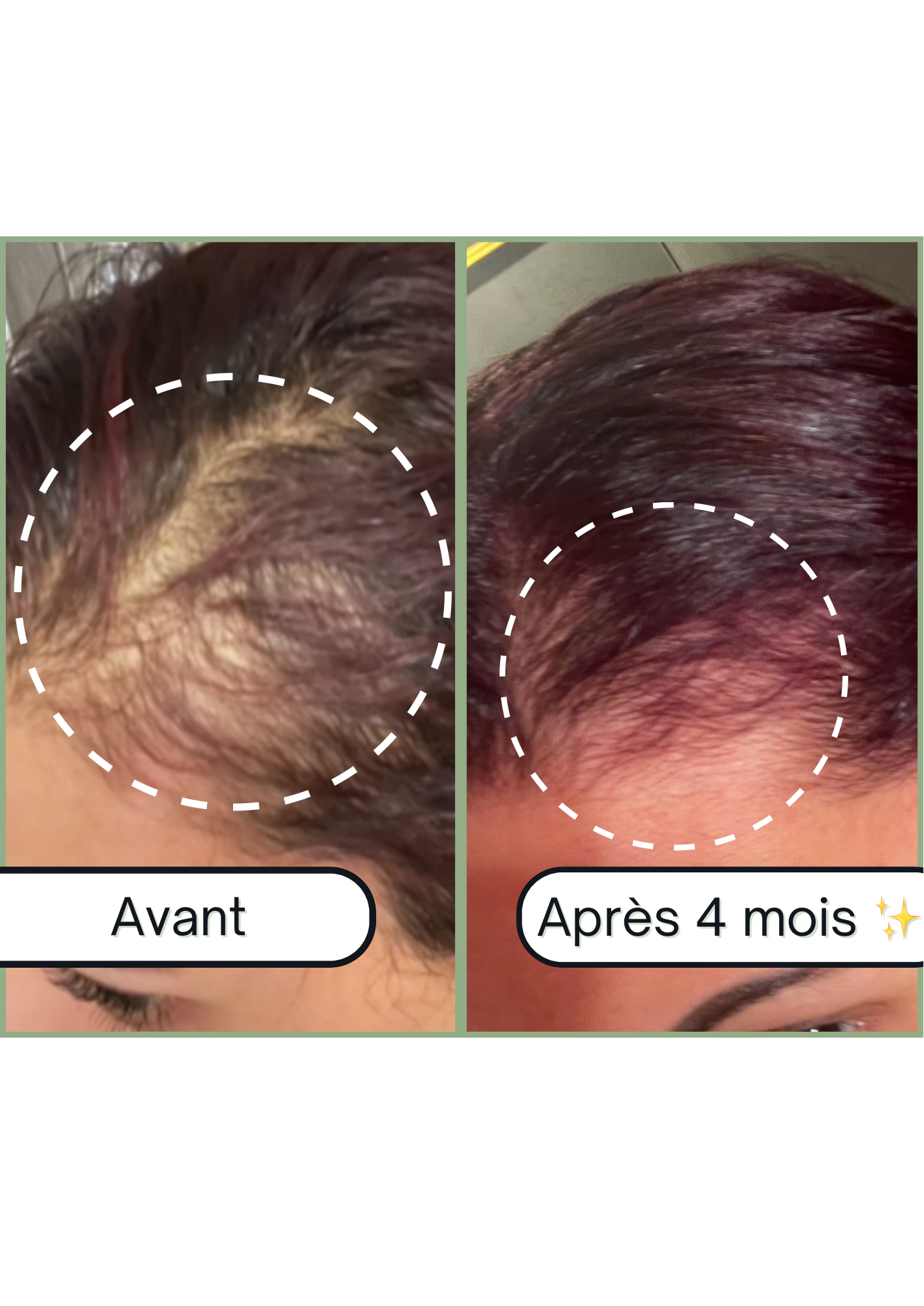 Accelerator Roll on Boost + : Roll-On pour la Pousse des Cheveux