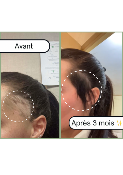 Accelerator Roll on Boost + : Roll-On pour la Pousse des Cheveux