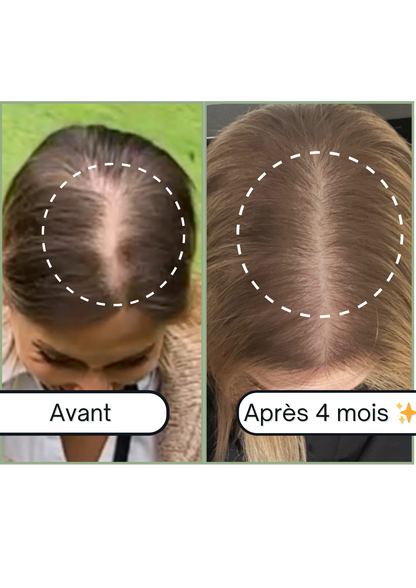 Accelerator Oil - Huile pour la pousse de cheveux &amp; Anti-chute naturelle