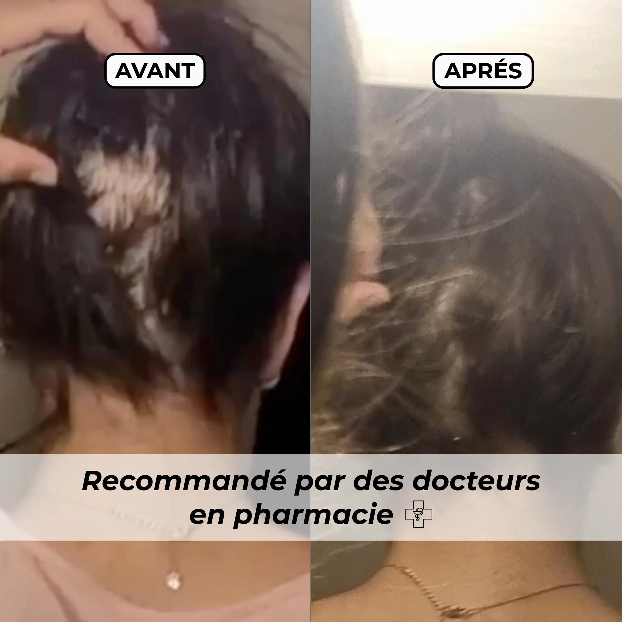 Avant et après utilisation du Roll-On pousse cheveux Biologist Mood – résultat visible, cheveux plus denses et croissance stimulée